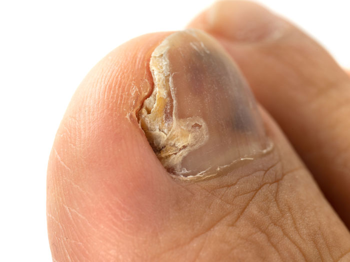 The Dangers of Nail Infections